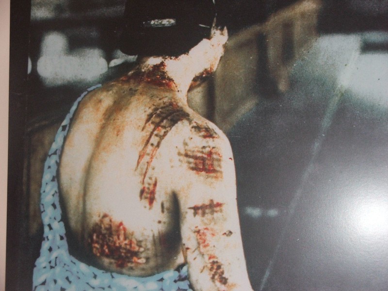 A woman displays radiation burns suffered in the atomic bombing of Hiroshima