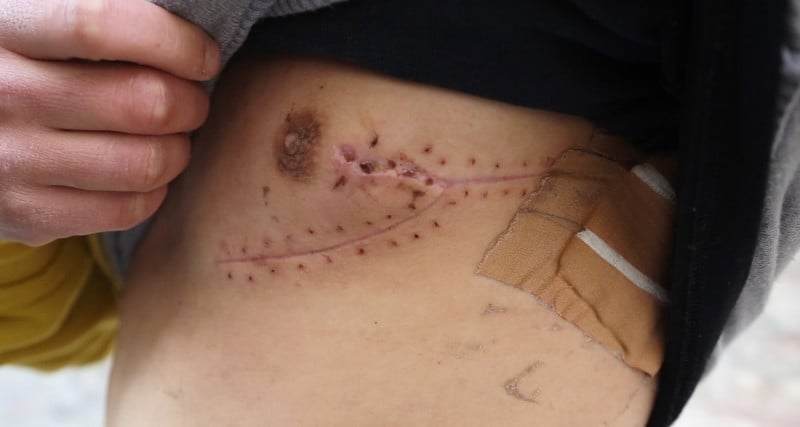 Close-up image of healing wound on child's chest