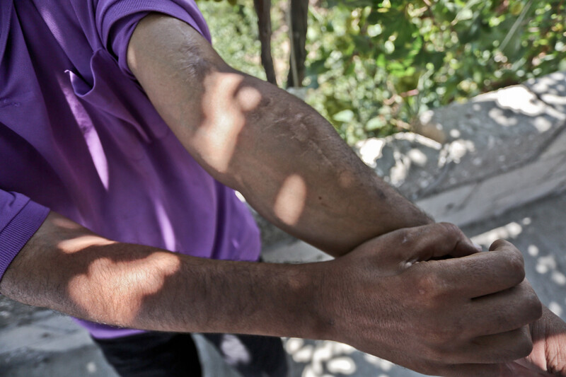 Close-up of scars on young man's arm