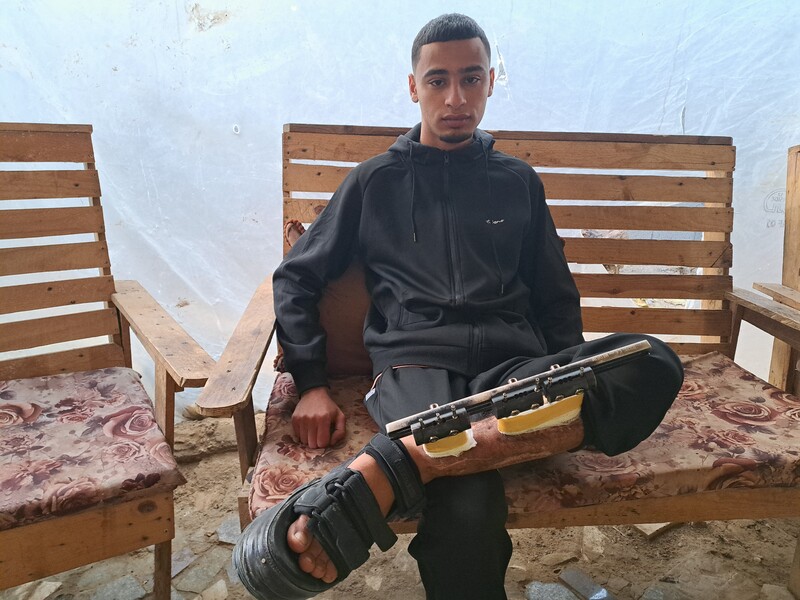 A young man sits on a bench with his leg in a splint