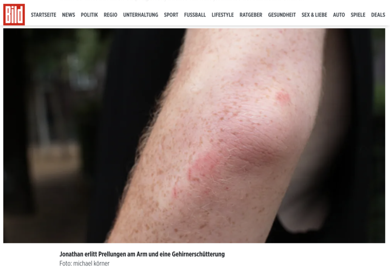 Close up of man's arm and elbow showing very faint scratches
