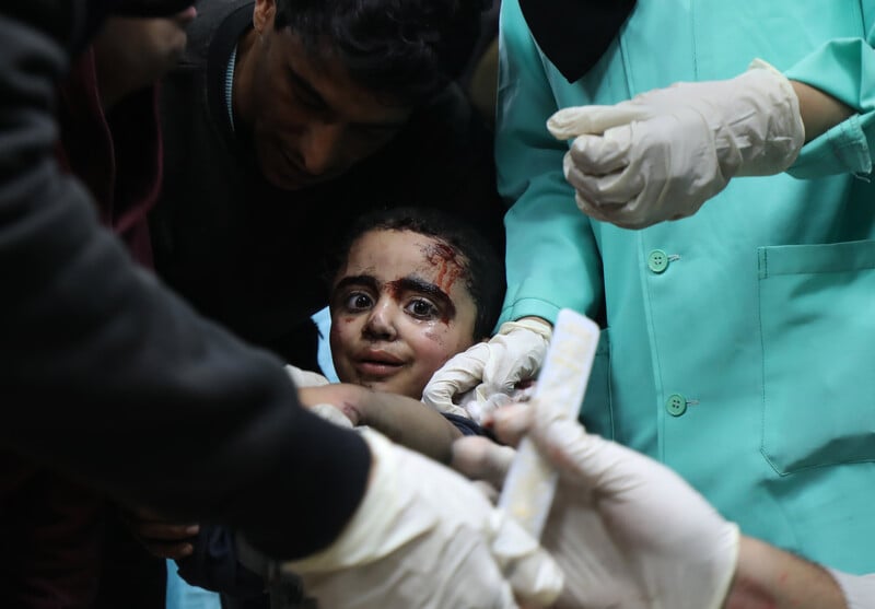 A child with wounds on his face is being treated by adults in hospital scrubs