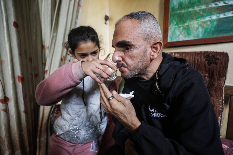 A girl is holding a glass of water and helping a man, whose left eye has been removed, drink