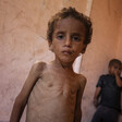 Portrait of an emaciated child