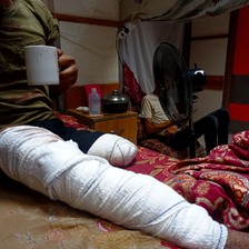 A man whose leg has been amputated sits on a bed and holds a mug