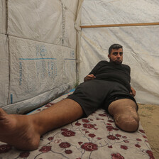 A man with one leg amputate lies on a bed in a tent.