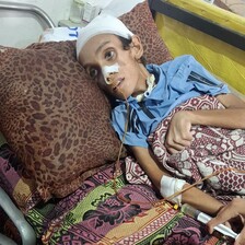An undernourished child lies in a hospital bed