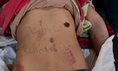 A child's wounded stomach is marked with his name in marker
