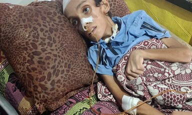 An undernourished child lies in a hospital bed